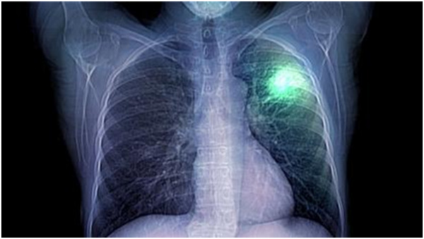 سرطان الرئة يتصدر قائمة السرطانات القاتلة للنساء