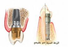 نجاح زراعة الأسنان يصل إلى 99% خلال الـ 50 سنة الماضية